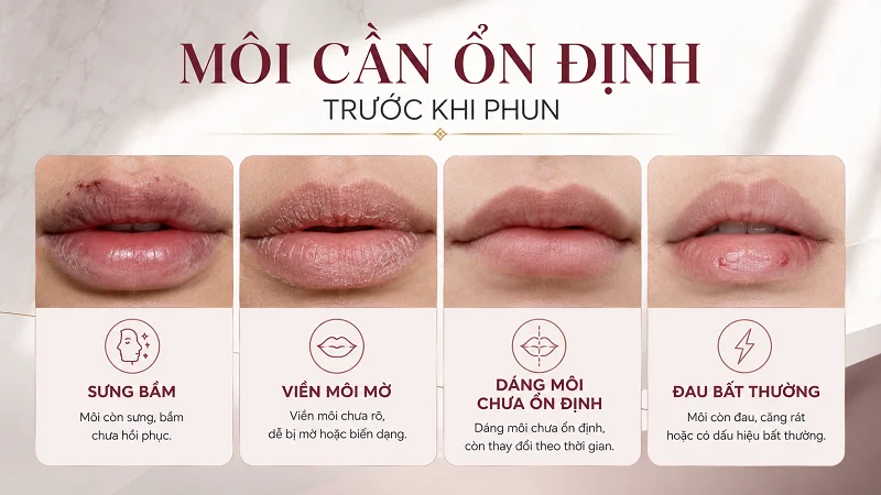 Sau filler, môi cần ổn định những gì trước khi phun? Sau filler, môi cần ổn định những gì trước khi phun?