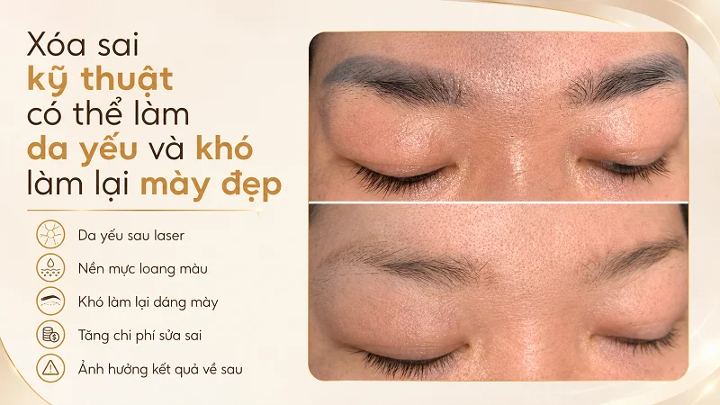 Xóa sai kỹ thuật ảnh hưởng gì đến việc làm lại chân mày? Xóa sai kỹ thuật ảnh hưởng gì đến việc làm lại chân mày?