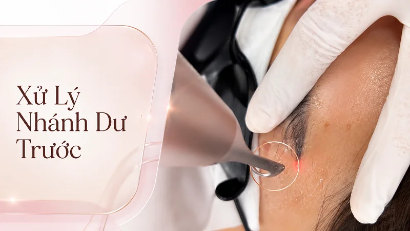 Laser thường là cách xử lý tốt nhất