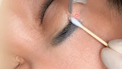 High-tech Laser Tattoo Removal