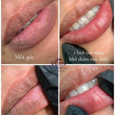 Khách hàng sử dụng dịch vụ khử thâm môi tại Luxie