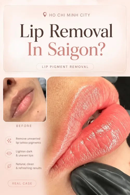 Lip Pigment Removal In Saigon